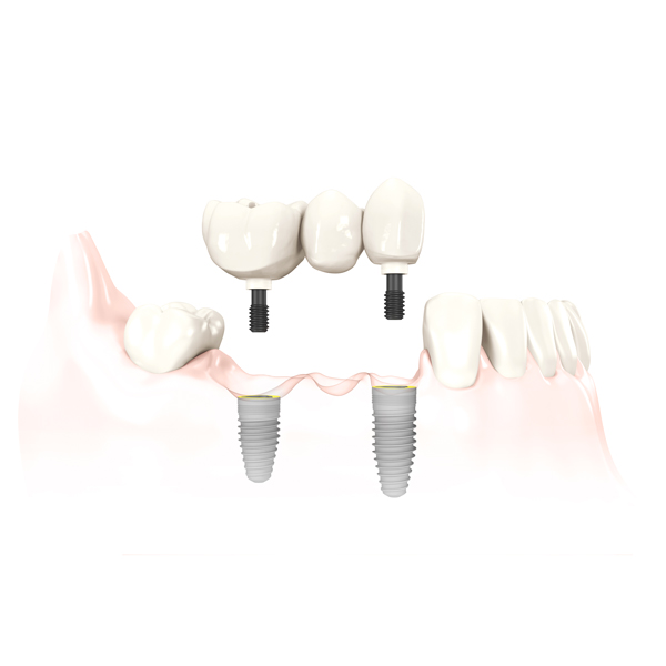 3-unit implant bridge