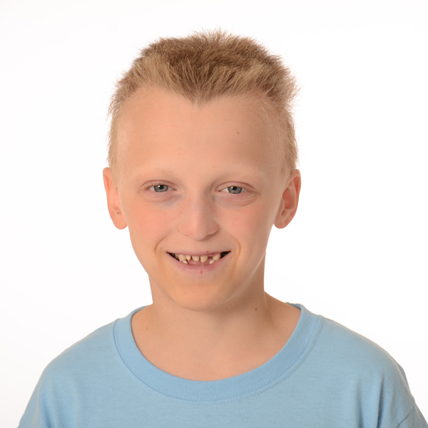 boy with Ectodermal Dysplasias