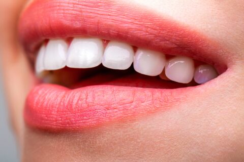 teeth whitening