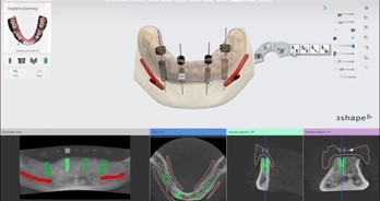 Dental Implant Planning